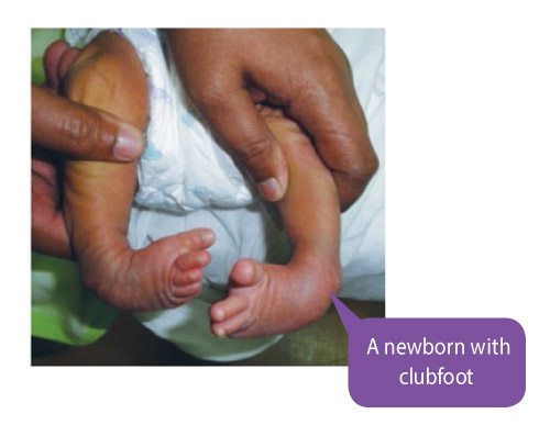 newborn-with-clubfoot