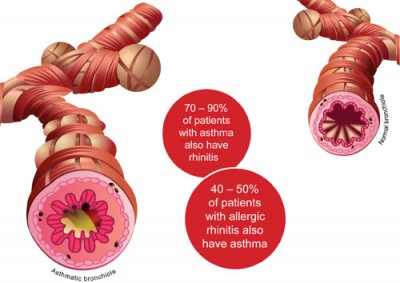 The Asthma-Rhinitis Connection - Positive Parenting