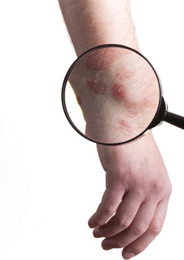 hand-with-eczema