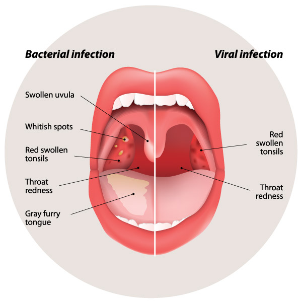 sore-throat-infection