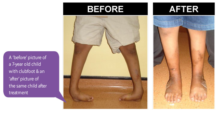 before-after-clubfoot
