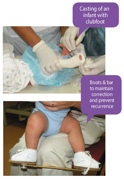 Treating Clubfoot Positive Parenting