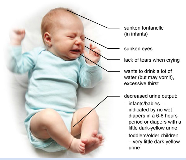 signs of dehydration in babies