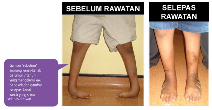 kaki-bengkok-sebelum-dan-selepas-rawatan