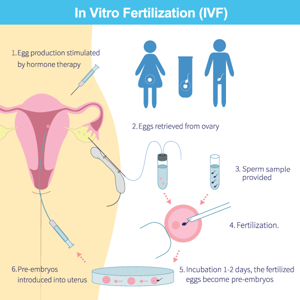 ivf