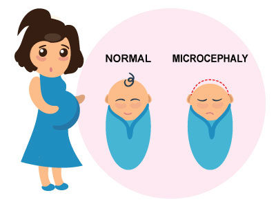 Zika infection during pregnancy