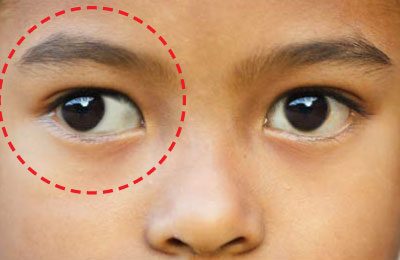 Figure 1: A child with right eye squint (strabismus)
