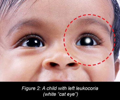 Figure 2: A child with left leukocoria (white "cat eye")