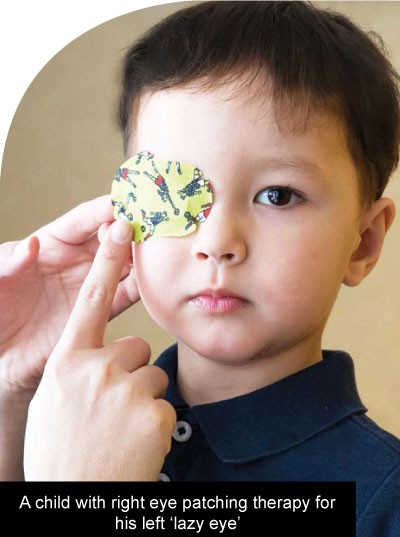 A child with right eye patching therapy for his left ‘lazy eye’