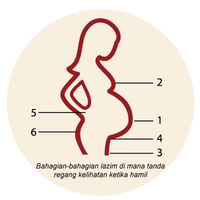 Bahagian-bahagian lazim di mana tanda regang kelihatan ketika hamil