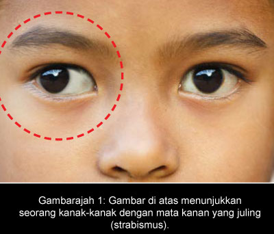 Gambarajah 1: Gambar di atas menunjukkan seorang kanak-kanak dengan mata kanan yang juling (strabismus).