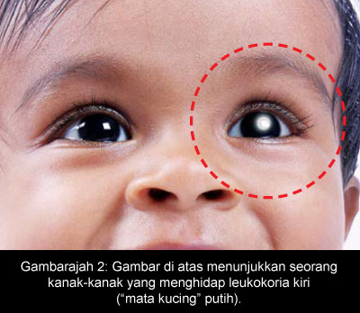 Gambarajah 2: Gambar di atas menunjukkan seorang kanak-kanak yang menghidap leukokoria kiri (“mata kucing” putih).