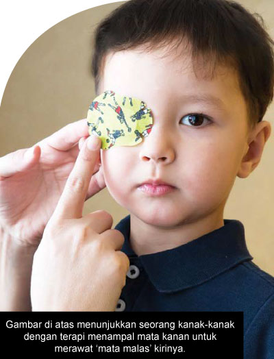 Gambar di atas menunjukkan seorang kanak-kanak dengan terapi menampal mata kanan untuk merawat ‘mata malas’ kirinya.