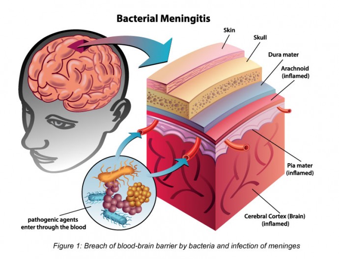 haemophilus influenzae meningitis