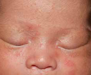 Jerawat bayi (neonatal acne)