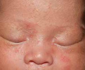 acne neonatorum vs erythema toxicum