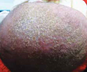 Dermatitis seborea (cradle cap)