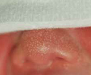 Neonatal sebaceous hyperplasia