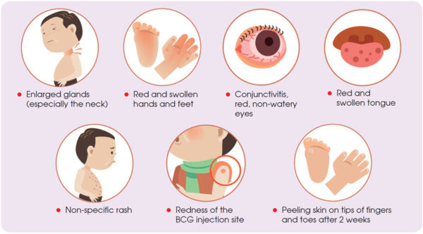 Signs and symptoms of Kawasaki disease