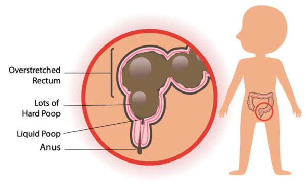 Diagram of overstretched rectum