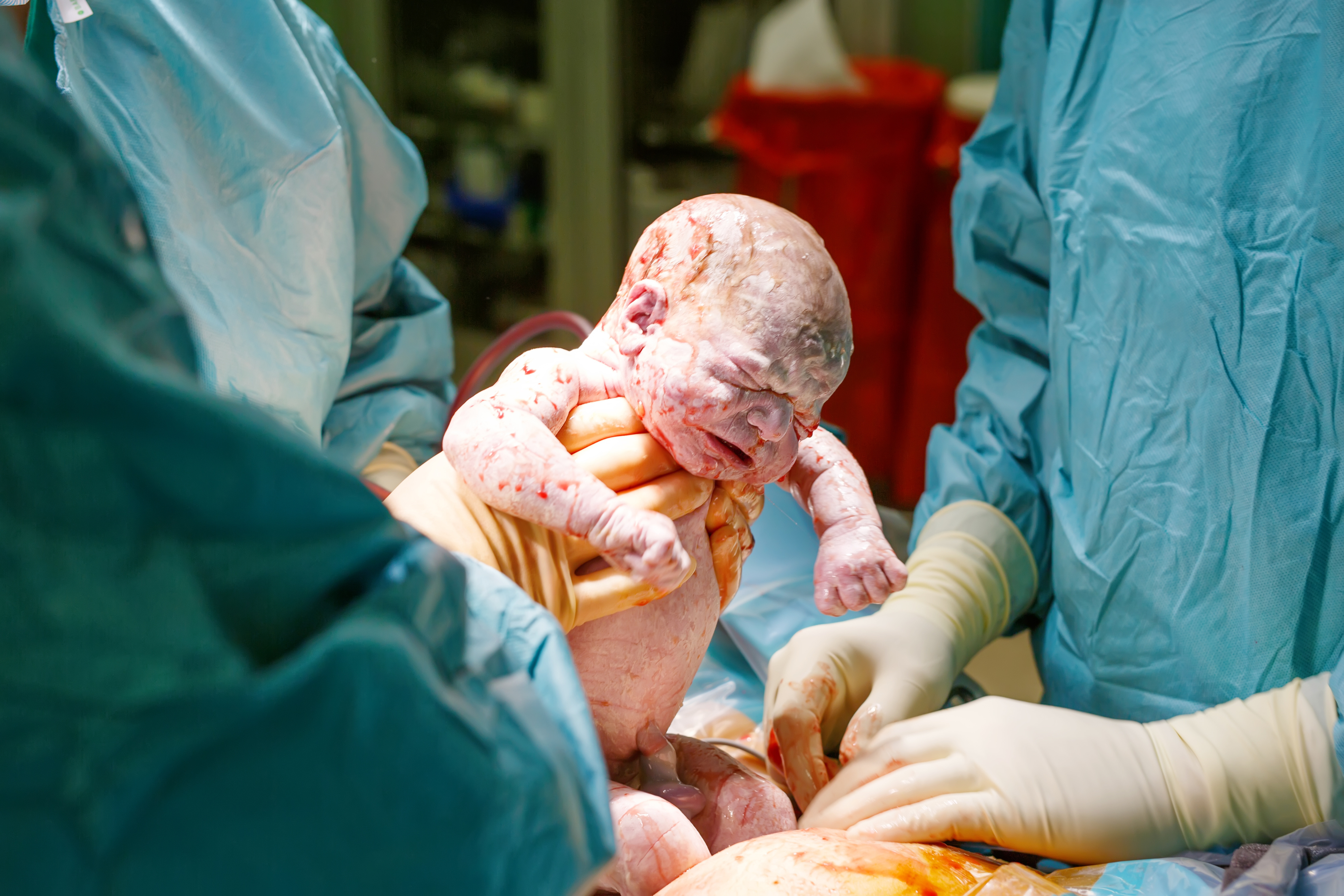  Baby  being born via Caesarean Section coming out Newborn 