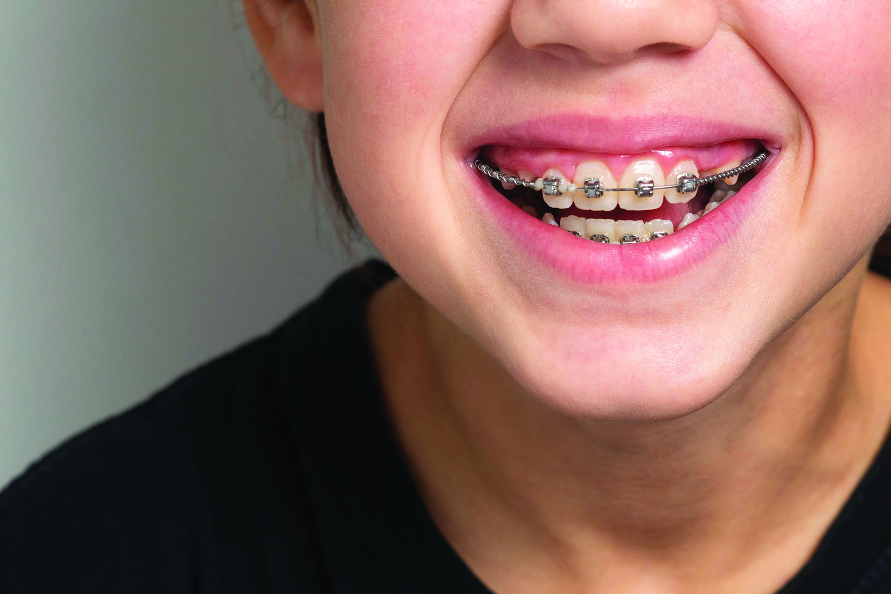 Dental Braces for Kids - Positive Parenting